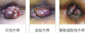 外痔图片